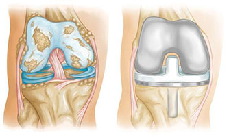Iran2africa-Evolis-total-knee-replacement-Orthopedic-prosthetics-f1-Product
