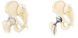 Iran2africa-Sheikh-Cementless-Hip-Implants-Orthopedic-Prosthetics-d-Product